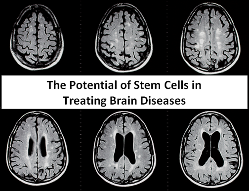 Stem cells for brain diseases