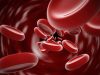 Chicago Doctors Use Stem Cells to Cure Sickle Cell Disease