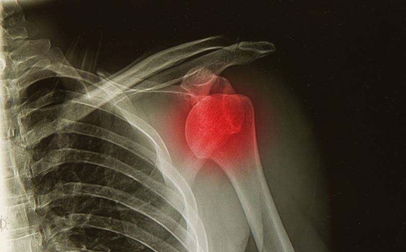 Innovation: Stem Cells For Shoulder Injuries