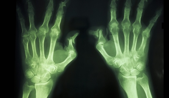 New Stem Cell Treatment Shows Promise for Rheumatoid Arthritis