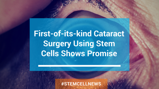 First-of-its-kind Cataract Surgery Using Stem Cells Shows Promise